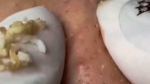 Терапия прыщей: смотреть и расслабляться 112