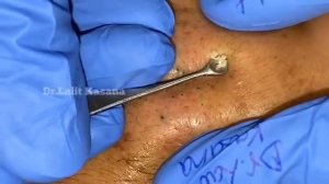 Глубокое очищение пор от комедонов 1112