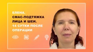 Елена. СМАС-подтяжка лица и шеи. 14 сутки после операции