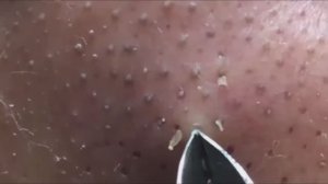 Asmr. Профессиональное удаление от черных точек.