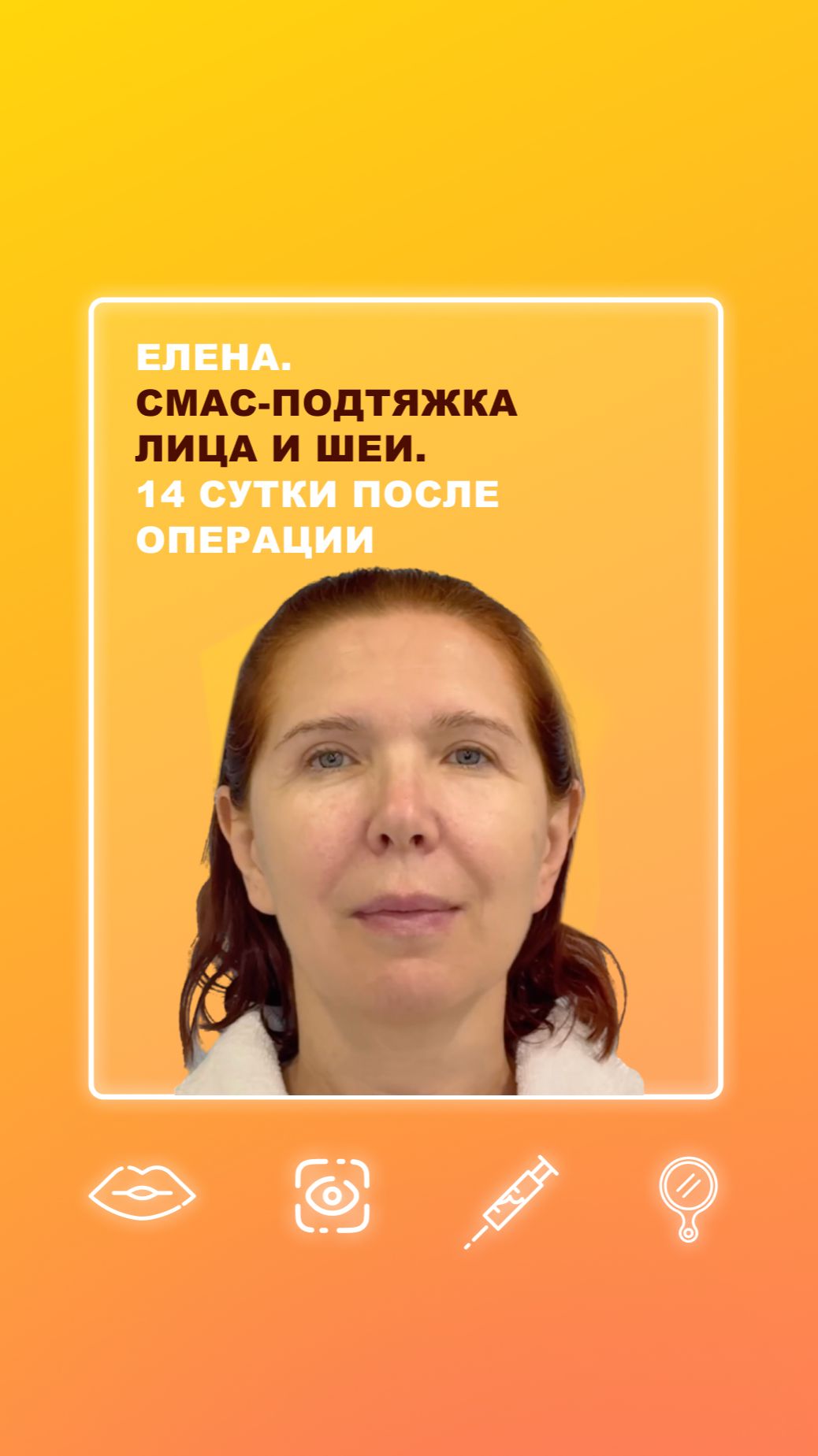 Елена. СМАС-подтяжка лица и шеи. 14 сутки после операции смотреть онлайн