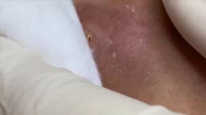 Большие прыщи: удаление гигантских фурункулов SDS#158