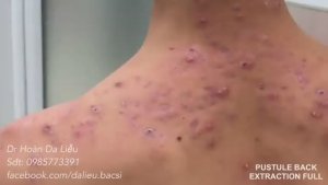 Много черных точек на спине: полная экстракция