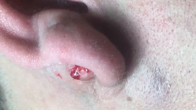 Прыщи на ушной раковине: экстракция и лечение