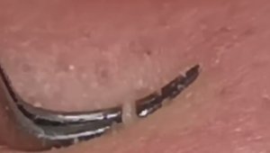 Чистка лица от угрей и акне. Выдавливание прыщей. Удаление черных точек и комедонов