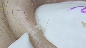 Раскрываем карты: лучший способ лечения прыщей