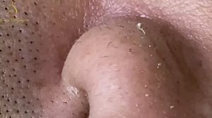 Очищение кожи от черных точек и сальных пробок. Asmr.