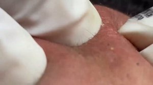 Выдавливание прыщей, угрей, черных точек и камедонов #217