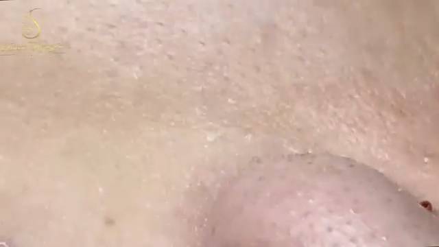 Лучшее лечение акне. Топ-1 метод