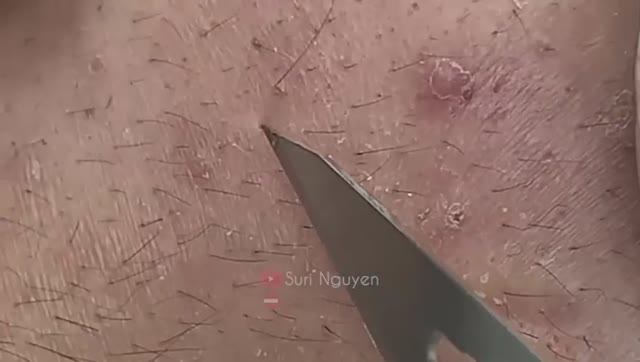 СУМАСШЕДШЕЕ удаление черных точек! Вы такого еще не видели! смотреть онлайн