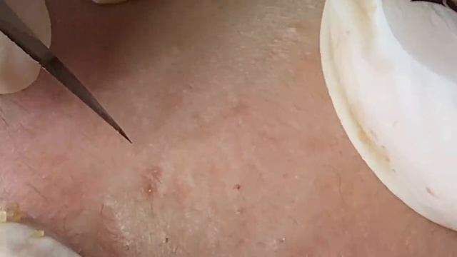 Что делать с прыщами под кожей? Эффективная чистка SDS#167 смотреть онлайн