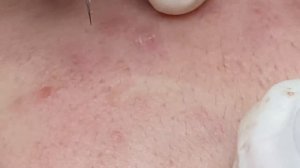 Закрытые комедоны и прыщи | Подкожные прыщи SDS#163