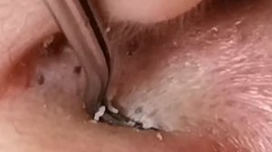 Чистка лица от угрей и акне. Выдавливание прыщей. Удаление черных точек и комедонов