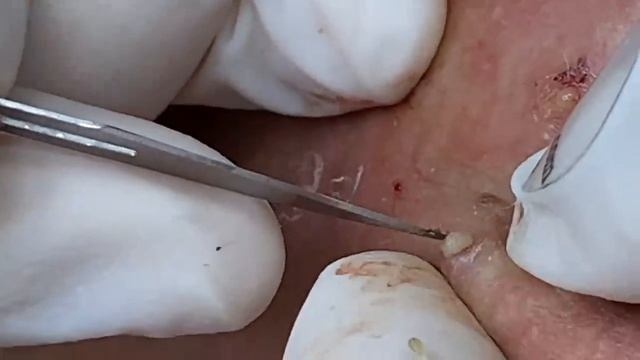 Супер быстрое выдавливание прыщей | Очищение черных точек SDS#164 смотреть онлайн