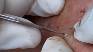 Супер быстрое выдавливание прыщей | Очищение черных точек SDS#164