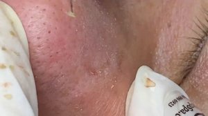 Подкожные прыщи | Как удалить закрытые комедоны SDS#160