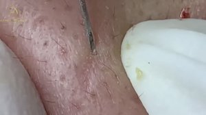 Эффективное лечение акне / То, что действительно помогает