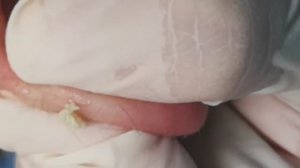 Чистка лица от угрей и акне. Выдавливание прыщей. Удаление черных точек и комедонов