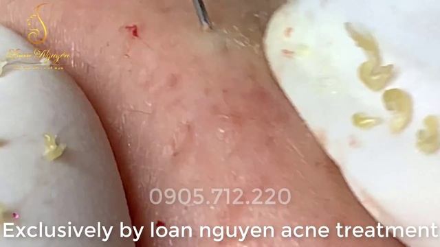 Идеальное извлечение: ищем и прокалываем черные точки и скрытые прыщи LN смотреть онлайн