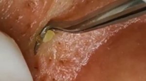 Чистка лица от угрей и акне. Выдавливание прыщей. Удаление черных точек и комедонов