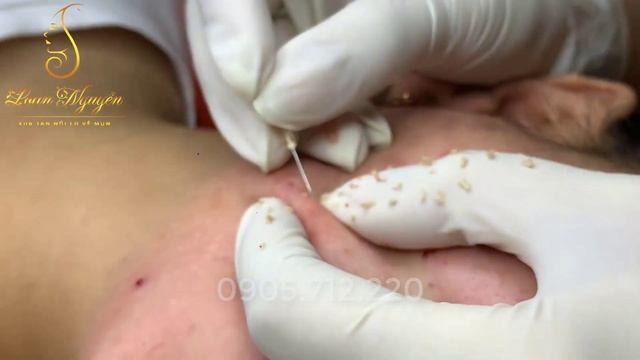 BLACKHEADS and whiteheads: экстракция комедонов 22 LN смотреть онлайн
