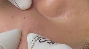 Чистка лица: глубокие черные точки и стержни SDS#165