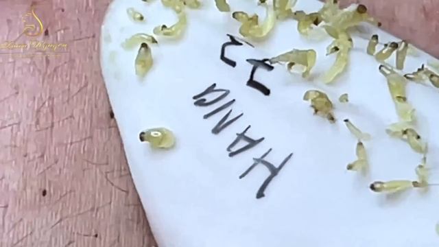 Профессиональный подход к удалению акне смотреть онлайн