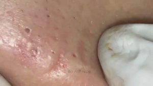 Расслабляющее удаление глубоких черных точек и прыщей