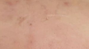 Удаление прыщей на лбу / Чистка лобной зоны SDS#157