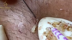 Осторожно! Шокирующая правда о чистке лица