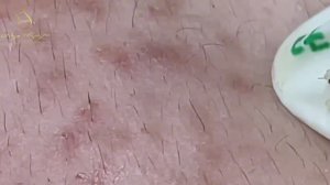 Битва за чистую кожу. Удаление Акне