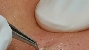 Чистка лица от угрей и акне. Выдавливание прыщей. Удаление черных точек и комедонов