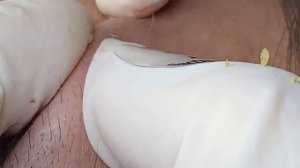 Прыщи, вызывающие неизгладимые рубцы SDS#161