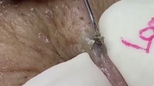 Asmr. Избавляемся от черных точек. 114