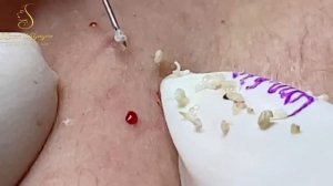 Выдавливание подкожных угрей. Asmr.