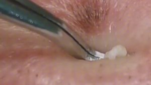 Чистка лица от угрей и акне. Выдавливание прыщей. Удаление черных точек и комедонов