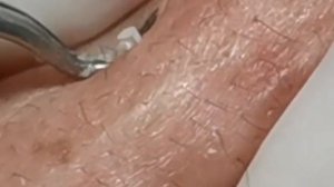 Чистка лица от угрей и акне. Выдавливание прыщей. Удаление черных точек и комедонов