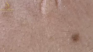 ХВАТИТ МУЧИТЬ КОЖУ! Ваше лечение акне может быть опасным