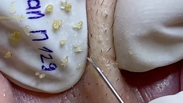 Секрет идеальной кожи: самое эффективное лечение акне