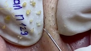 Секрет идеальной кожи: самое эффективное лечение акне