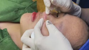 Прыщи, вызывающие неизгладимые рубцы SDS#161