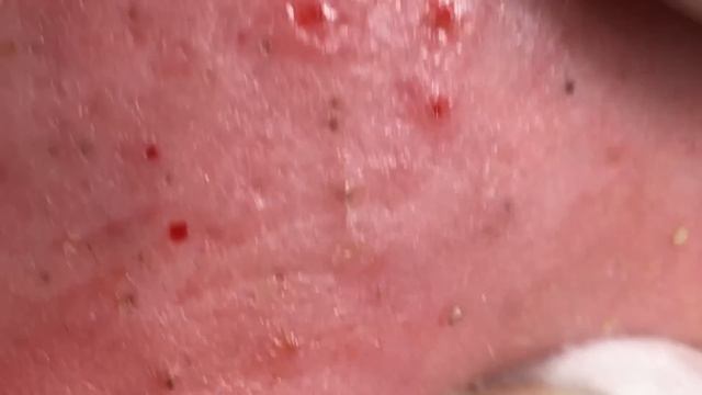 Реальная процедура: удаление прыщей смотреть онлайн