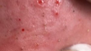 Реальная процедура: удаление прыщей