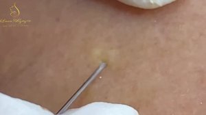 Лучшие техники удаления акне / Секреты экспертов раскрыты