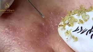 Секреты лечения акне раскрыты