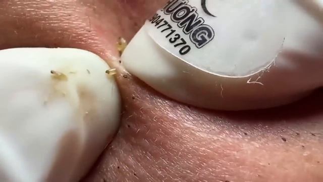 Выдавливание прыщей, угрей, черных точек и камедонов #218 смотреть онлайн