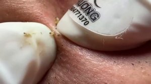 Выдавливание прыщей, угрей, черных точек и камедонов #218