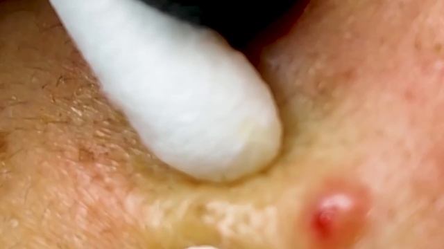 Чистка лица от угрей и акне. Выдавливание прыщей. Удаление черных точек и комедонов смотреть онлайн