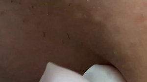 Выдавливание прыщей, угрей, черных точек и камедонов #221