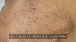 Выдавливание прыщей со стержнем. Профессиональная чистка. 90306